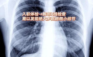 AI读片肺结节过度诊断怎么办？