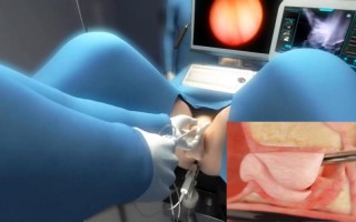 机器人前列腺根除术有何优势？