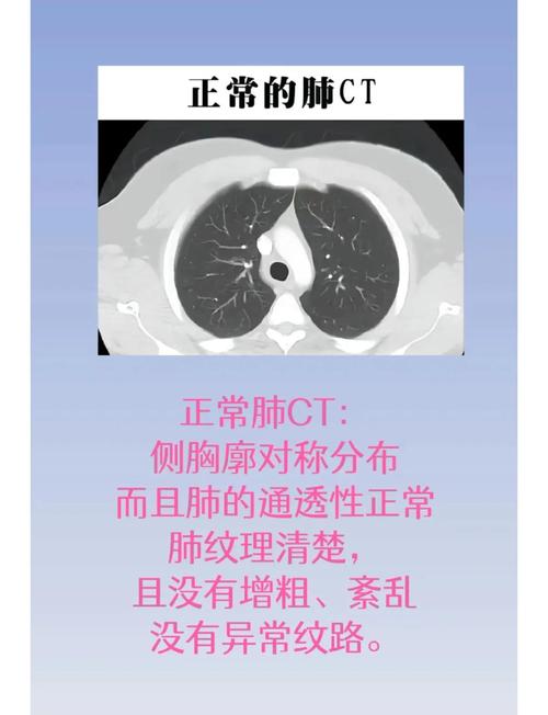 AI读片肺结节过度诊断怎么办？-第3张图片-广州国自机器人