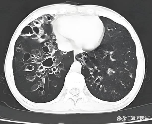 AI读片肺结节过度诊断怎么办？-第2张图片-广州国自机器人