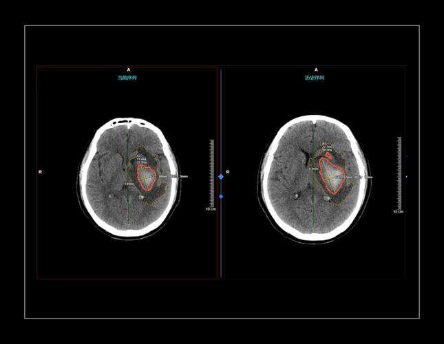 有关人工智能在ct血管-第3张图片-广州国自机器人 有关人工智能在ct血管-第3张图片-广州国自机器人