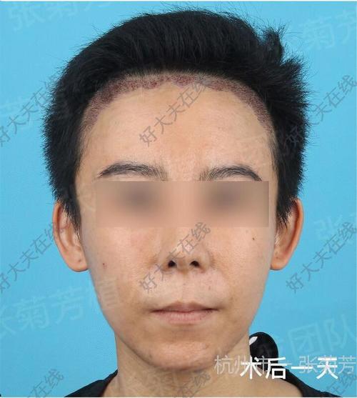 artas植发机器人价格到底多少钱？-第3张图片-广州国自机器人