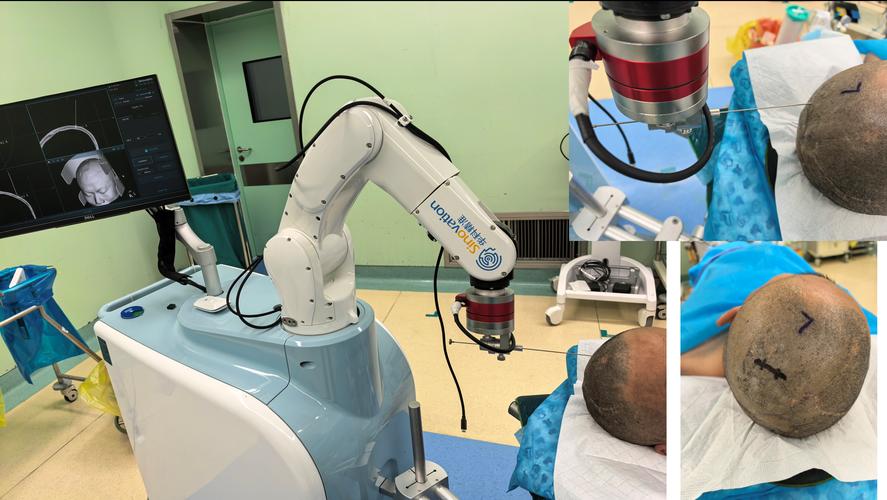 机器人做手术安全吗?-第2张图片-广州国自机器人 机器人做手术安全吗?-第2张图片-广州国自机器人