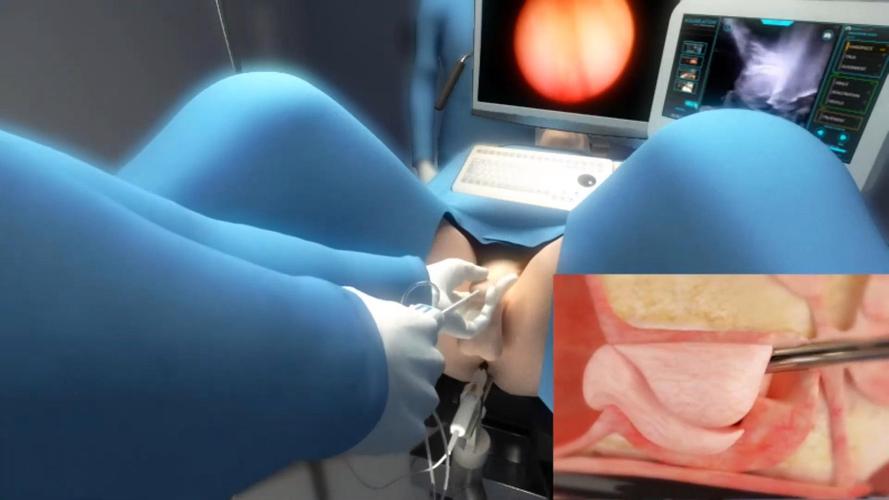 机器人前列腺根除术有何优势？-第1张图片-广州国自机器人